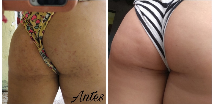 Antes e depois Tend Skin — pele tratada após foliculite e pelos encravados